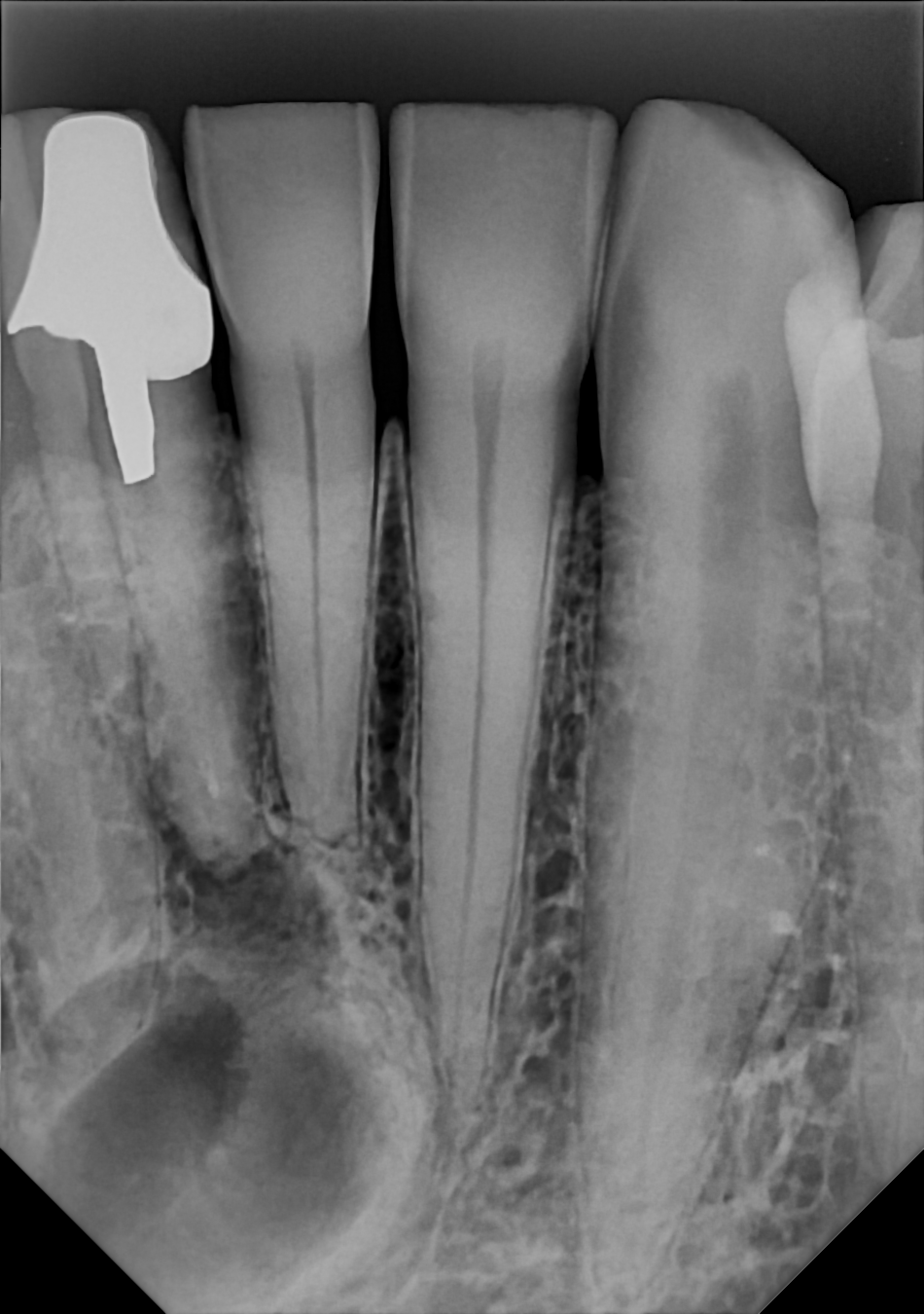 An example anterior periapical radiograph acquired with the DC-Air® wireless dental x-ray sensor.