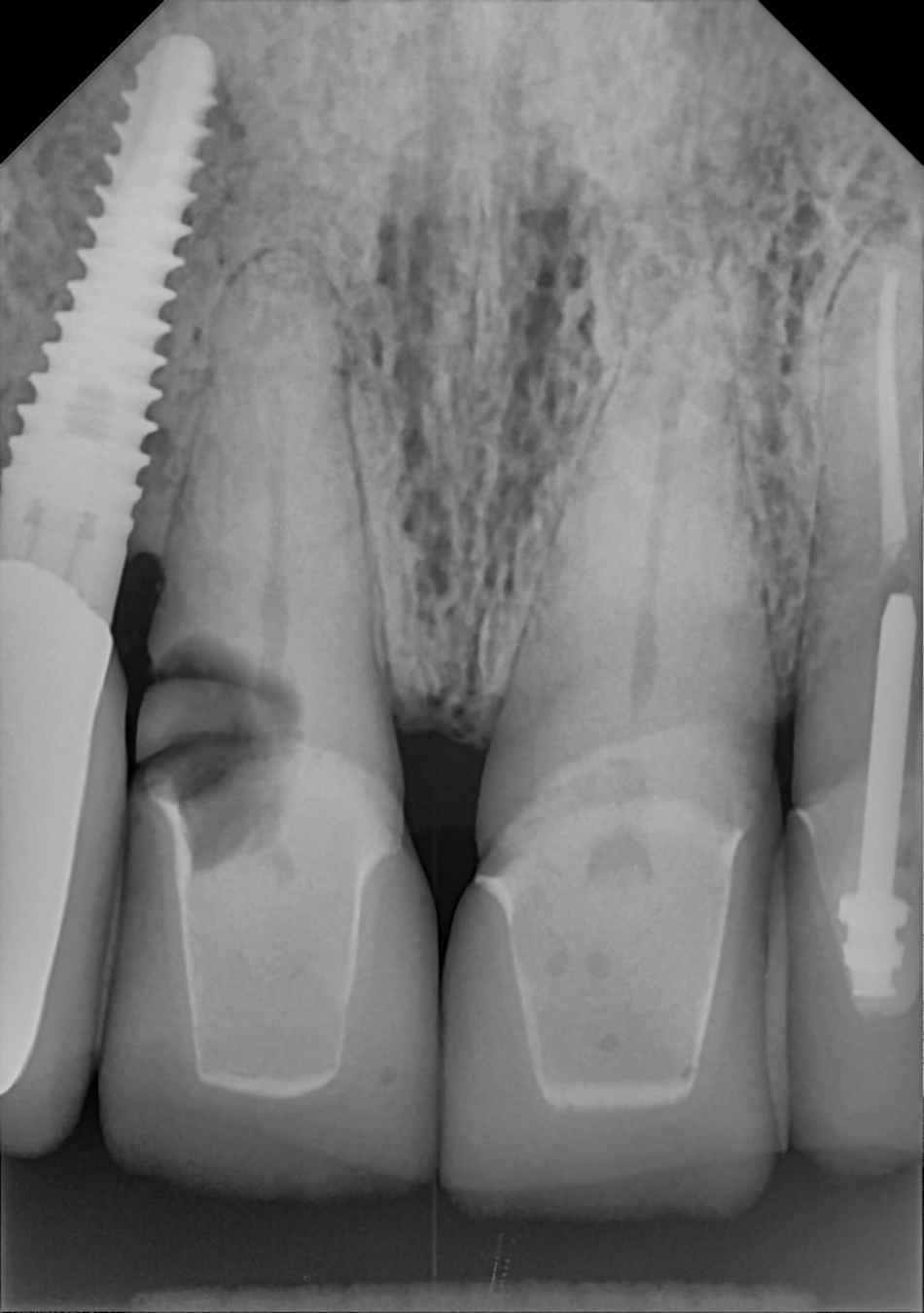 An example anterior periapical radiograph acquired with the DC-Air® wireless dental x-ray sensor.