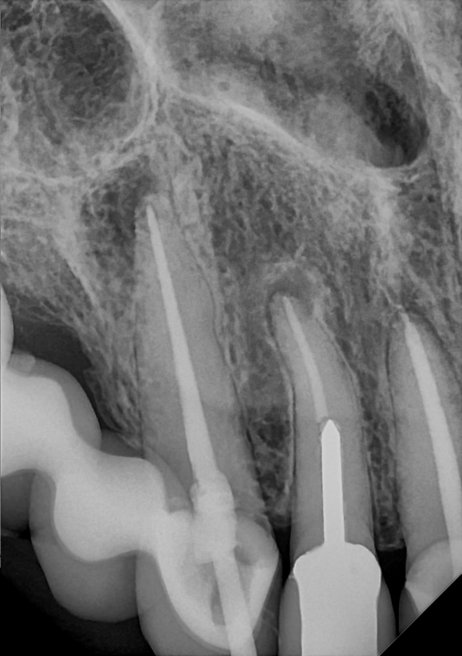 An example anterior periapical radiograph acquired with the DC-Air® wireless dental x-ray sensor.