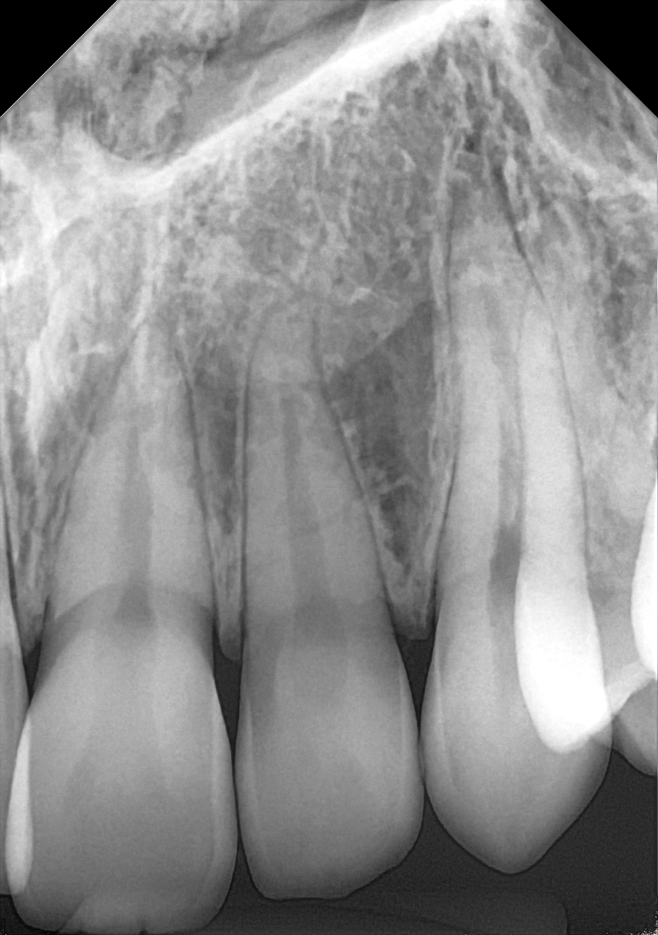 An example anterior periapical radiograph acquired with the DC-Air® wireless dental x-ray sensor.