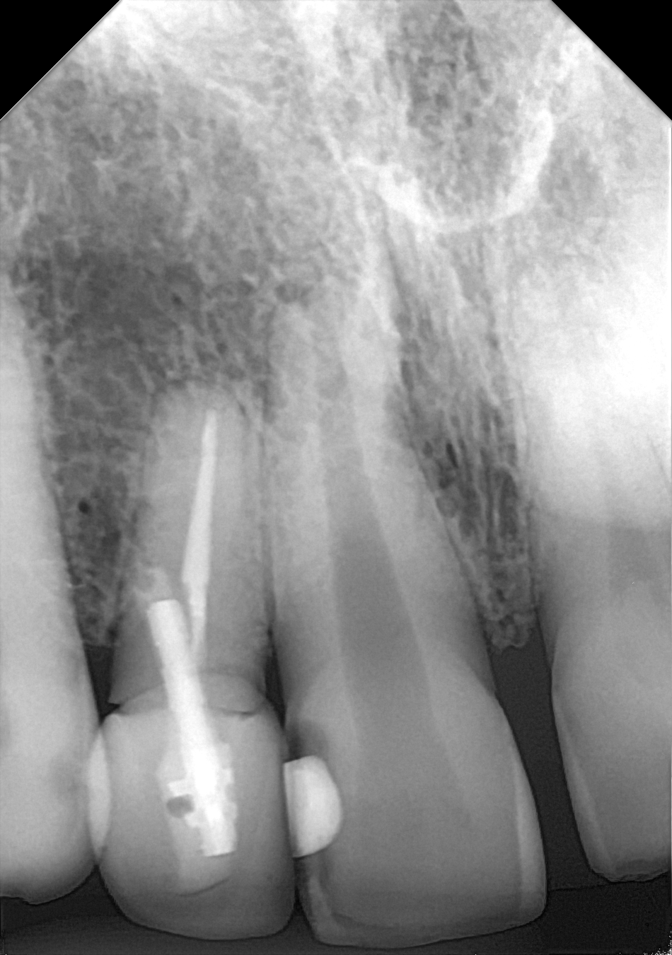 An example anterior periapical radiograph acquired with the DC-Air® wireless dental x-ray sensor.
