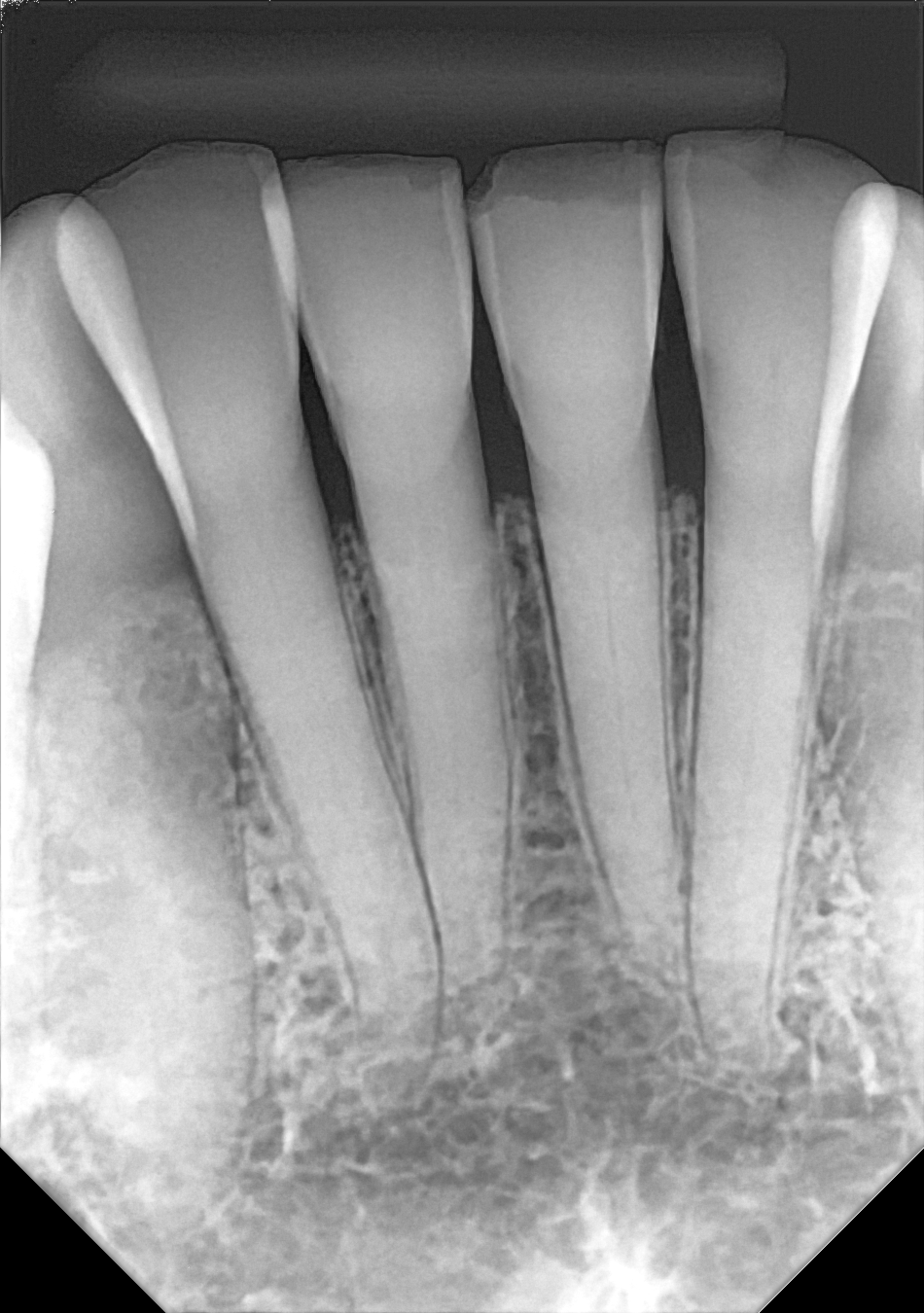 An example anterior periapical radiograph acquired with the DC-Air® wireless dental x-ray sensor.