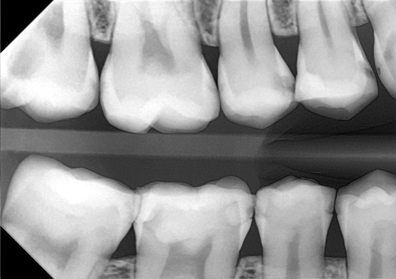 An example bitewing radiograph acquired with the DC-Air® wireless dental x-ray sensor.