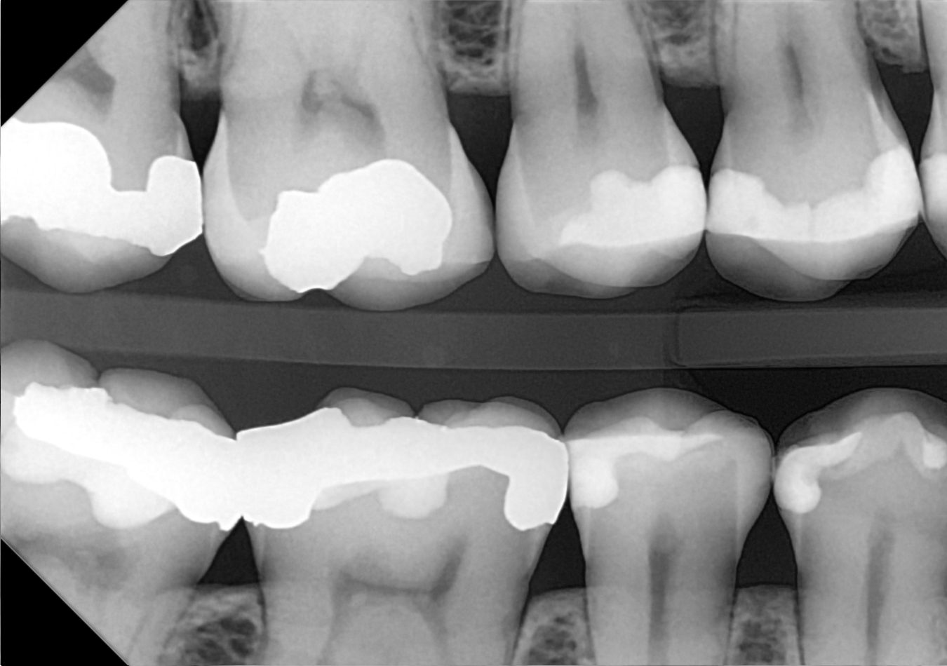 An example bitewing radiograph acquired with the DC-Air® wireless dental x-ray sensor.