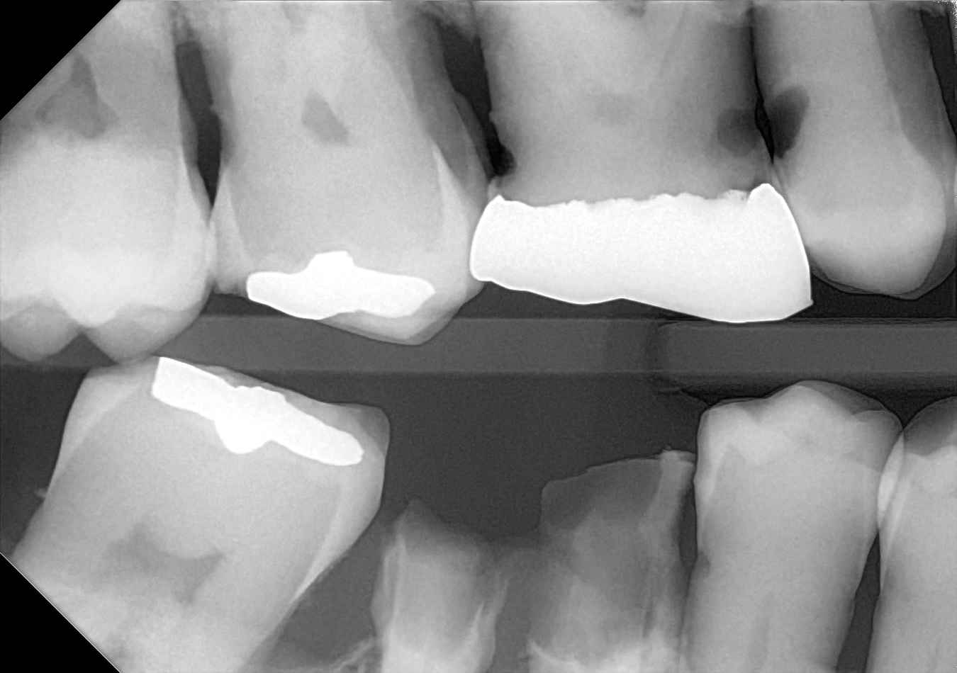 An example bitewing radiograph acquired with the DC-Air® wireless dental x-ray sensor.