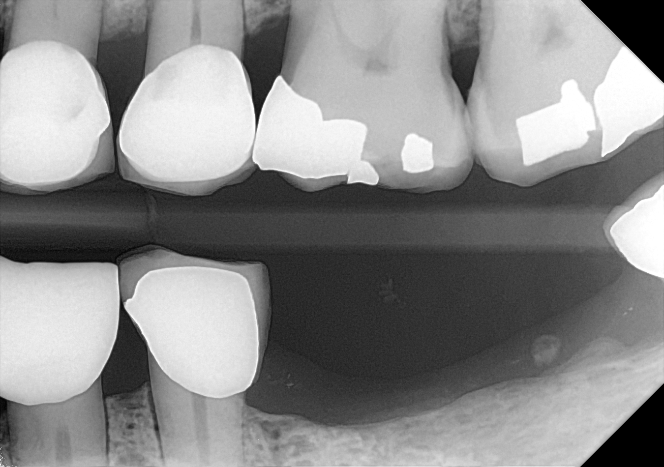 An example bitewing radiograph acquired with the DC-Air® wireless dental x-ray sensor.