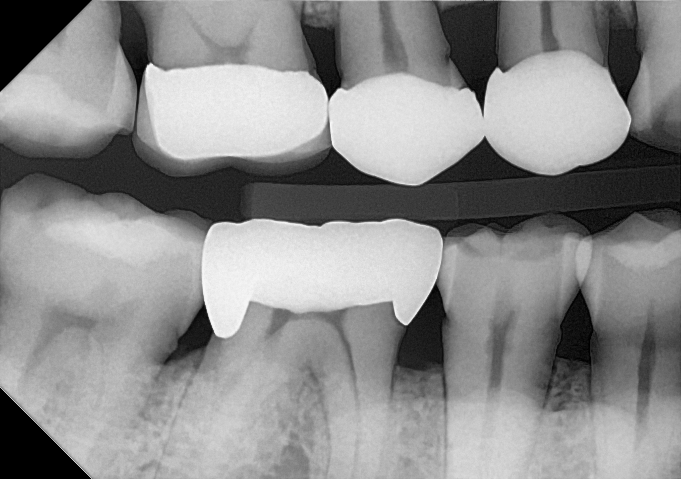 An example bitewing radiograph acquired with the DC-Air® wireless dental x-ray sensor.