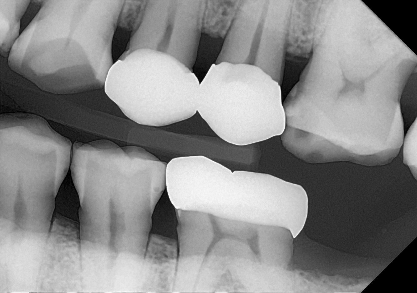 An example bitewing radiograph acquired with the DC-Air® wireless dental x-ray sensor.