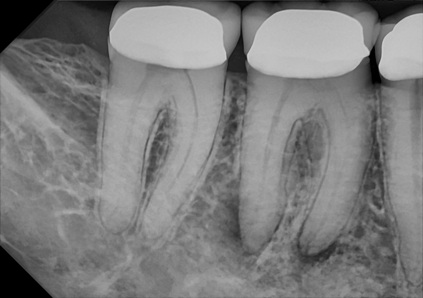An example posterior periapical radiograph acquired with the DC-Air® wireless dental x-ray sensor.