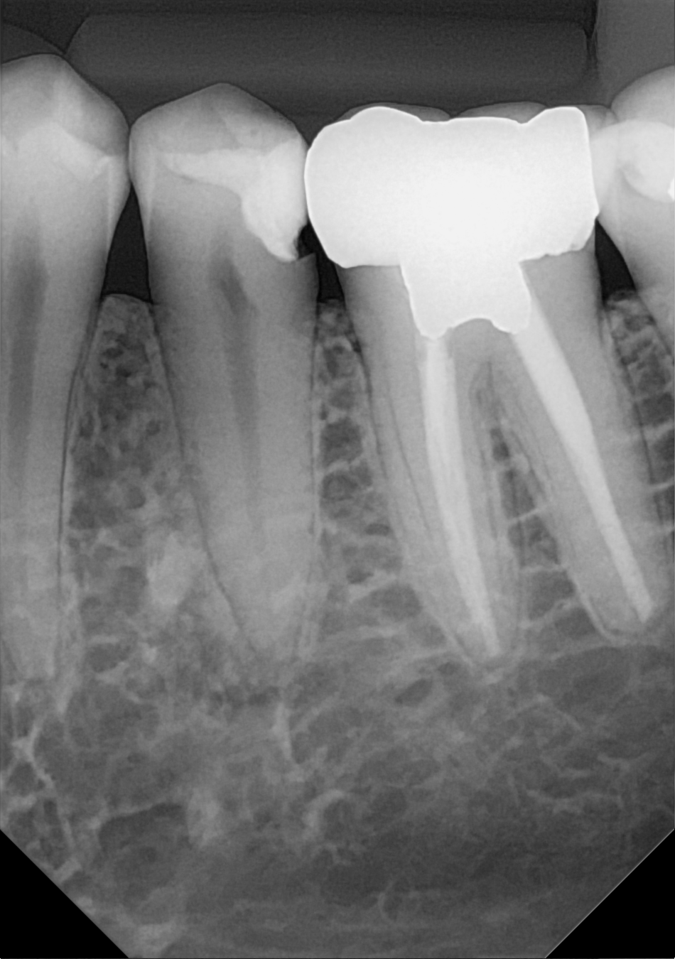 An example posterior periapical radiograph acquired with the DC-Air® wireless dental x-ray sensor.