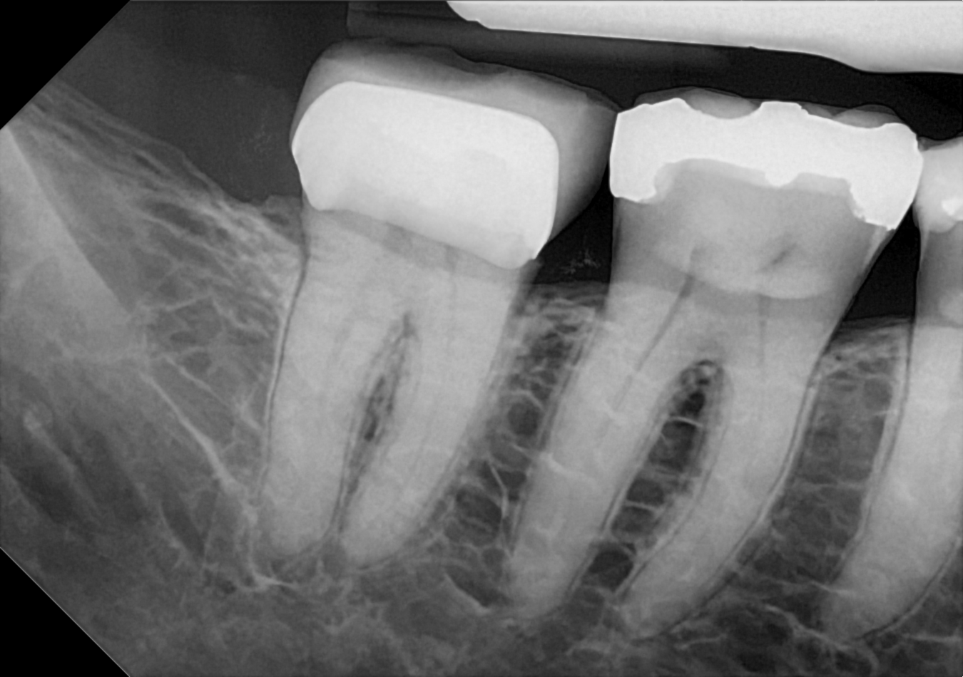An example posterior periapical radiograph acquired with the DC-Air® wireless dental x-ray sensor.