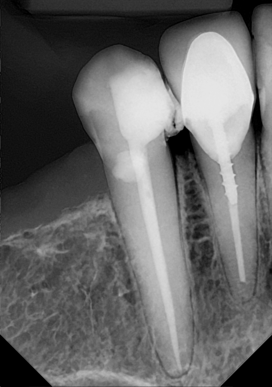 An example posterior periapical radiograph acquired with the DC-Air® wireless dental x-ray sensor.