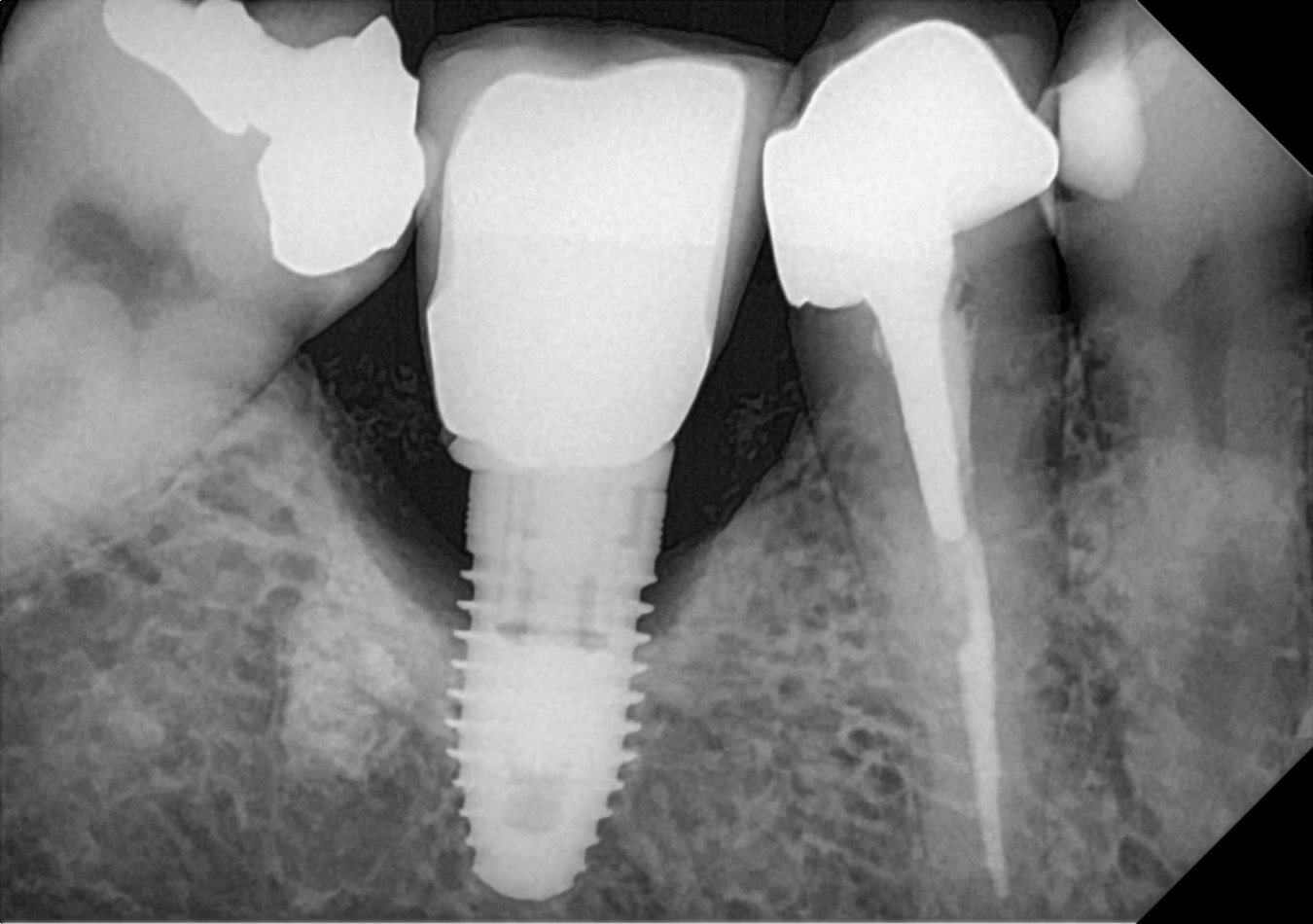 An example posterior periapical radiograph acquired with the DC-Air® wireless dental x-ray sensor.