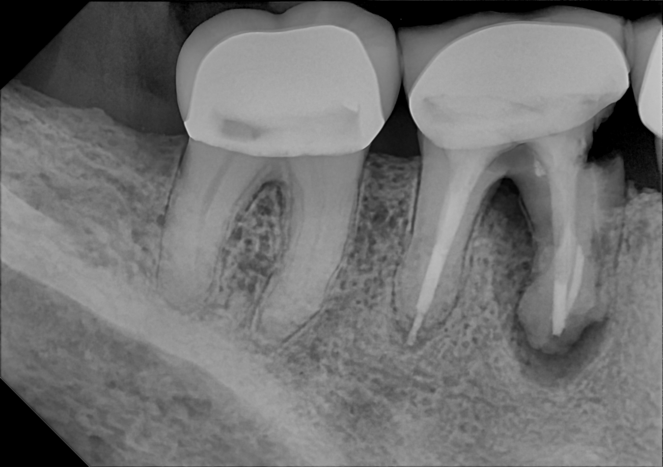An example posterior periapical radiograph acquired with the DC-Air® wireless dental x-ray sensor.