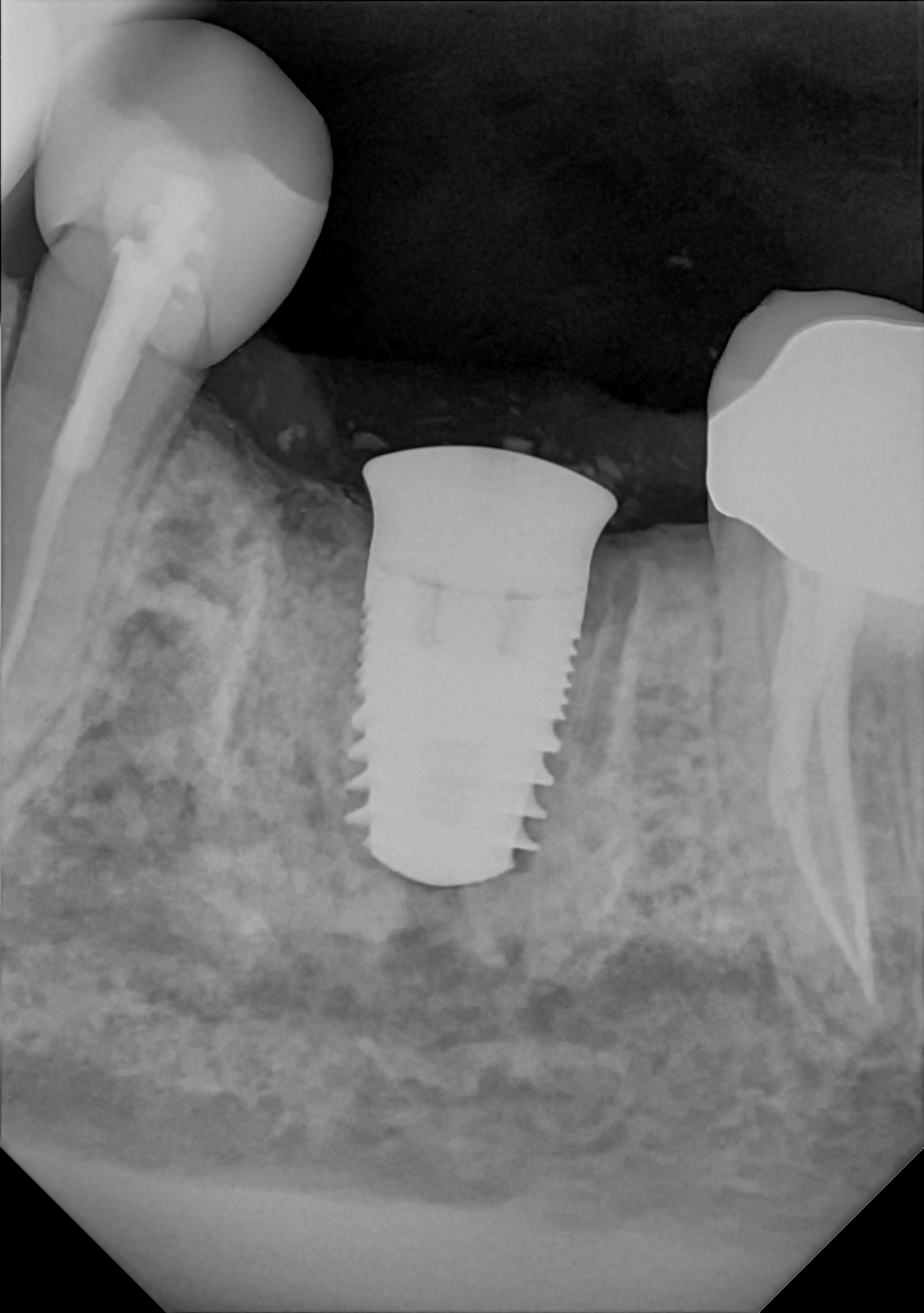 An example radiograph acquired with the Zero Profile® Endodontic holder for the DC-Air® wireless dental x-ray sensor.